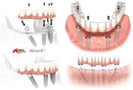 New Smile Dental Clinic Dental Services Oral Surgery Phuket Thailand